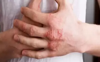 أسباب إكزيما اليد.. وهذه طرق علاجها