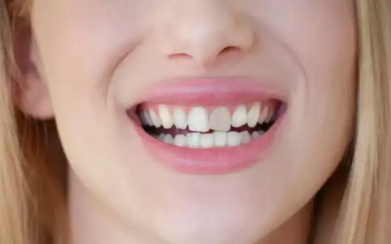 ما أسباب ظهور البقع على الأسنان؟