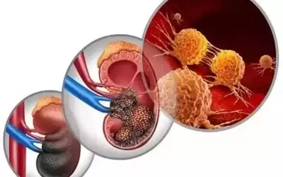 8 أعراض لسرطان الكلى .. احذر