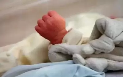 ولادة طفل بذيل بشري بحالة طبية
