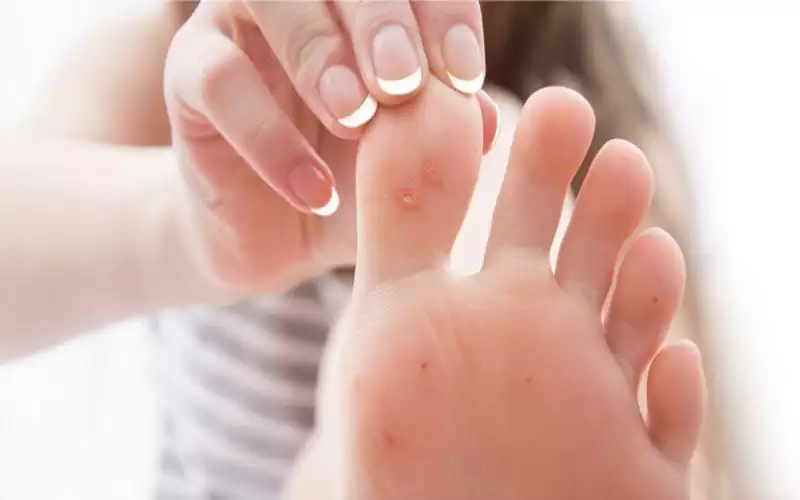 كيف تتخلص من مشكلة مسمار القدم؟