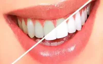 طرق طبيعية فعالة لتبييض الأسنان منزليا..