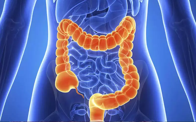 أبرز أسباب الإصابة بالتهاب القولون التقرحي