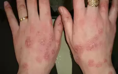 كيف تحمي نفسك من نوبات الإكزيما