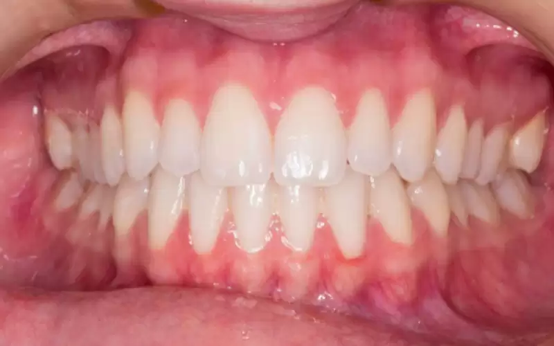 ضرس العقل.. أسباب تأخر ظهوره في