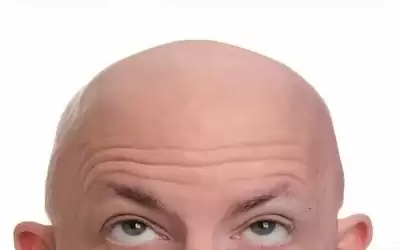 قطع رأس رجل أصلع للاعتقاد بوجود