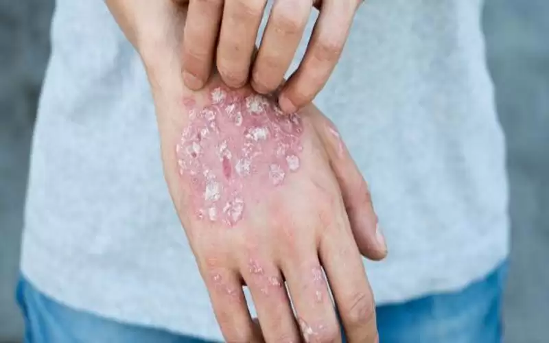 من أمراض المناعة الذاتية.. ماذا تعرف