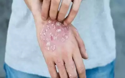 من أمراض المناعة الذاتية.. ماذا تعرف