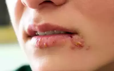 كيف تحمي نفسك من قروح البرد
