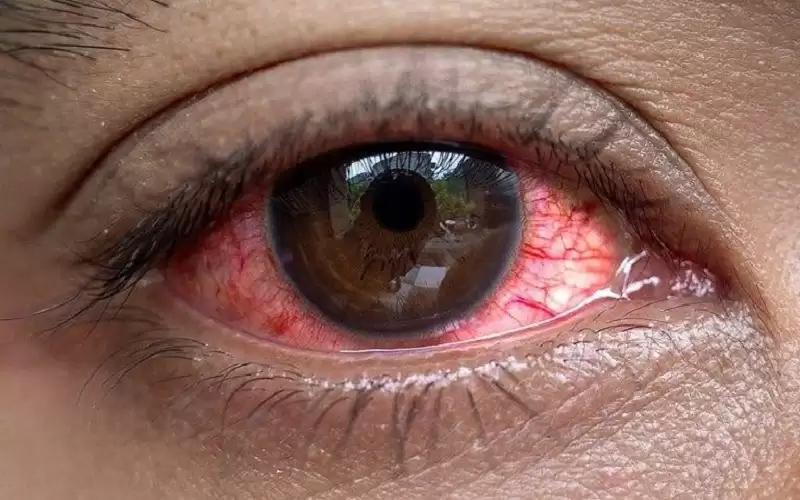 أسباب غير متوقعة لـ جفاف العين