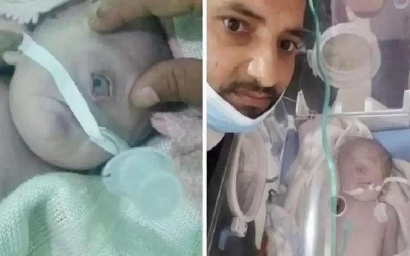 ولادة طفل بعين واحدة في اليمن