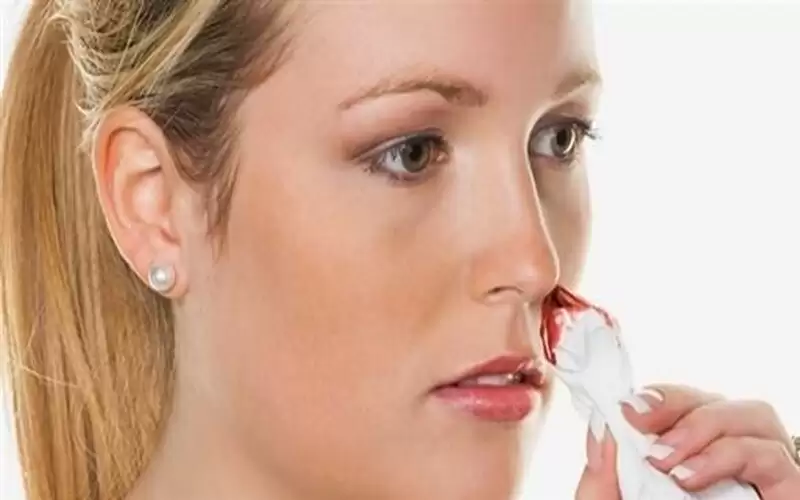 نزيف الأنف قد ينذر بالإصابة بمرض
