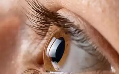 انفصال شبكية العين.. الأسباب والأعراض والعلاج