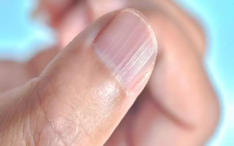 كيف تكتشف أنك مصاب بنقص الزنك؟