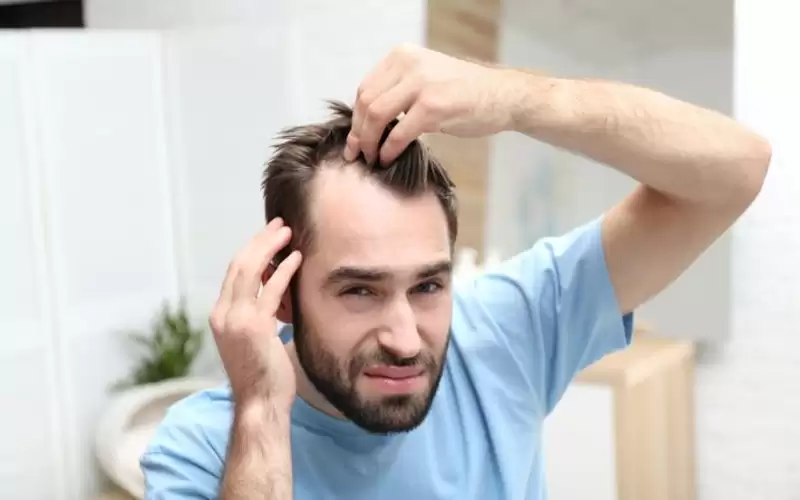 5 عوامل رئيسية تسبب تساقط الشعر