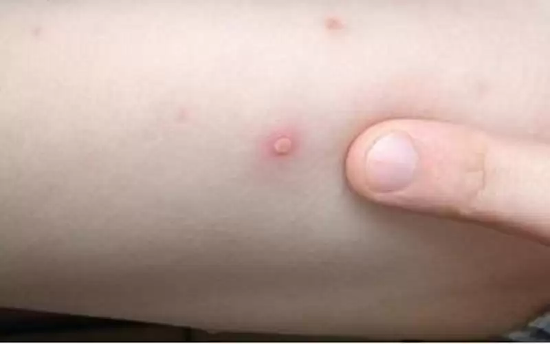 مكافحة الأوبئة: نراقب تسجيل حالات جدري