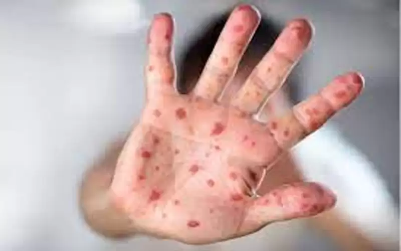 النمسا تسجل أول حالة يشتبه بإصابتها