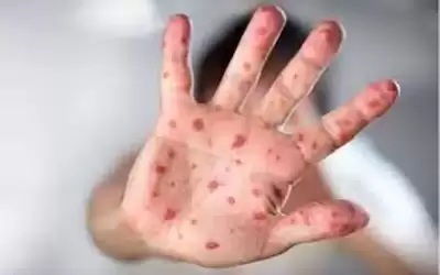 النمسا تسجل أول حالة يشتبه بإصابتها