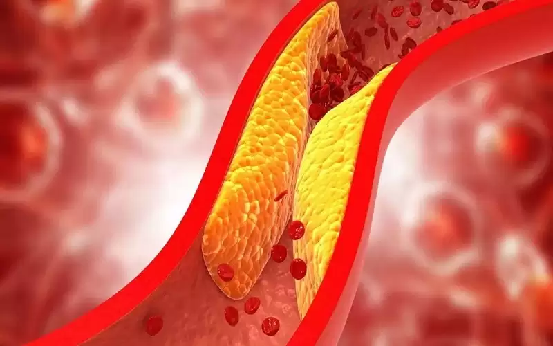 مؤشرات غريبة لارتفاع الكوليسترول