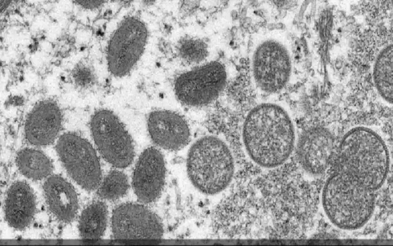 6 خرافات حول جدري القرود ..