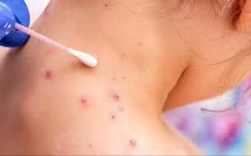 قرار مرتقب للصحة العالمية حول جدري