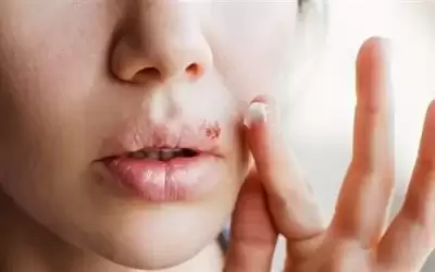 هربس الوجه فيروس يعود إلى 5