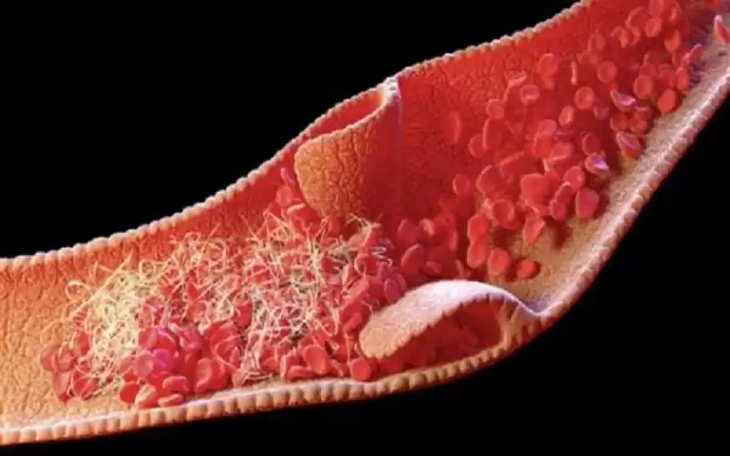 6 أعراض تدل على وجود جلطات