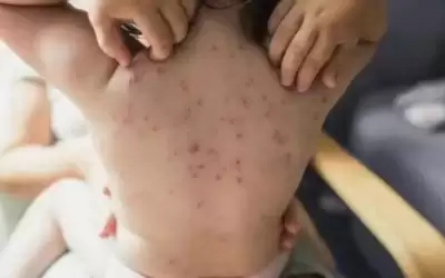 الأردن يسجل أول إصابة بمرض جدري
