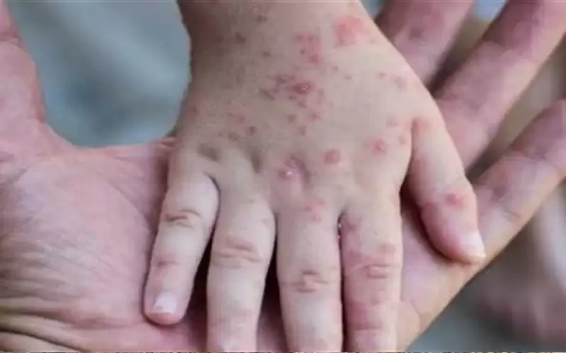 روسيا تعلن تسجيل إصابة ثانية بجدري