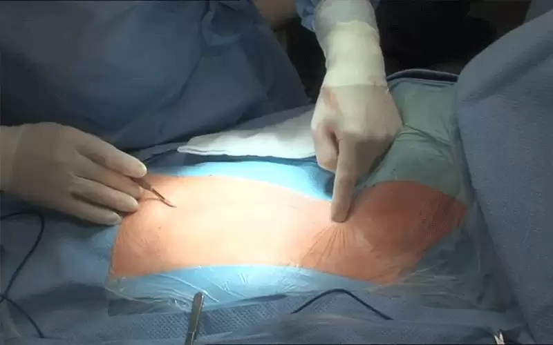 شفط دهون يفضي إلى الموت ..