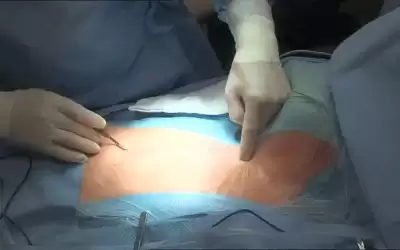 شفط دهون يفضي إلى الموت ..