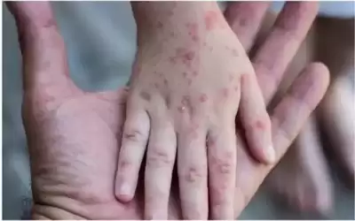 البحرين تعلن تسجيل أول إصابة بجدري