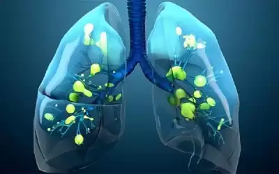 علاج جديد للتليف الكيسي يحدث تغييرا