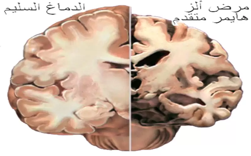 نتائج مشجعة لعلاج جديد لـألزهايمر