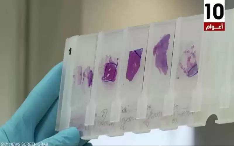 دراسة تفتح الباب أمام تبسيط العلاج