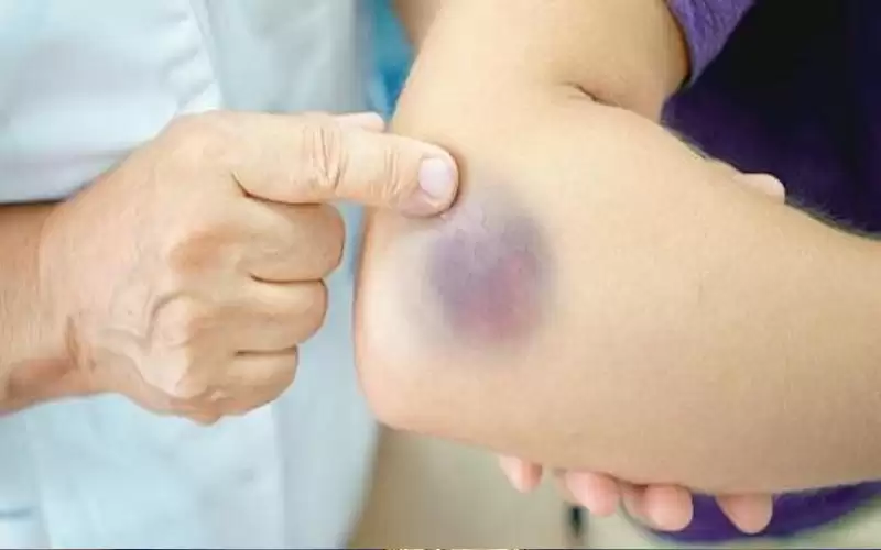 كدمات الجسم تشير لـ 5 أمراض