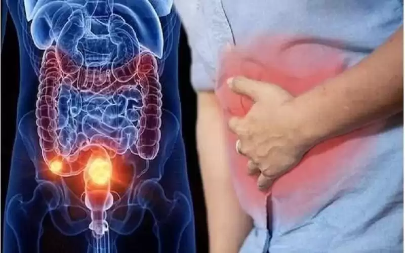 أطعمة يجب تجنبها لمرضي سرطان القولون