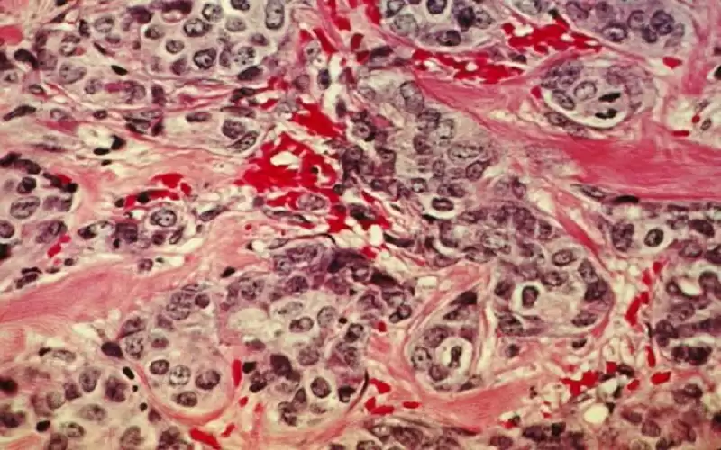 ابتكار مجهر لرؤية خلايا سرطانية بحجم