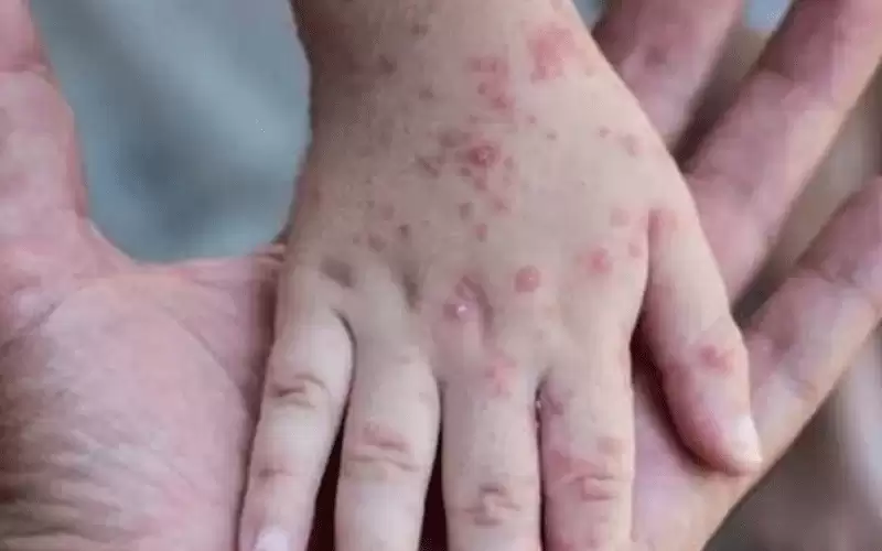 الصحة العالمية: جدري القرود لايزال حالة