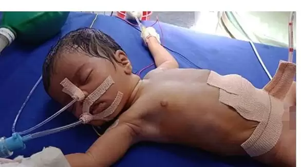 ولادة رضيعة بثمانية أجنة في بطنها