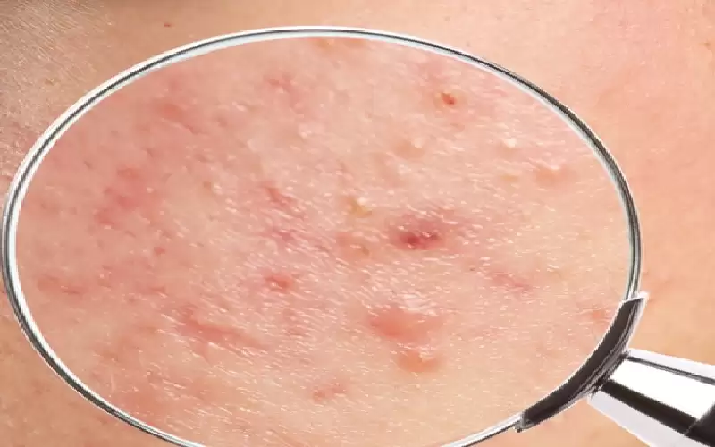 هل هناك فوائد لاستخدام الشامبو المضاد