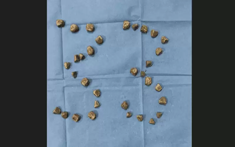 إزالة 33 حصوة من مثانة خمسيني