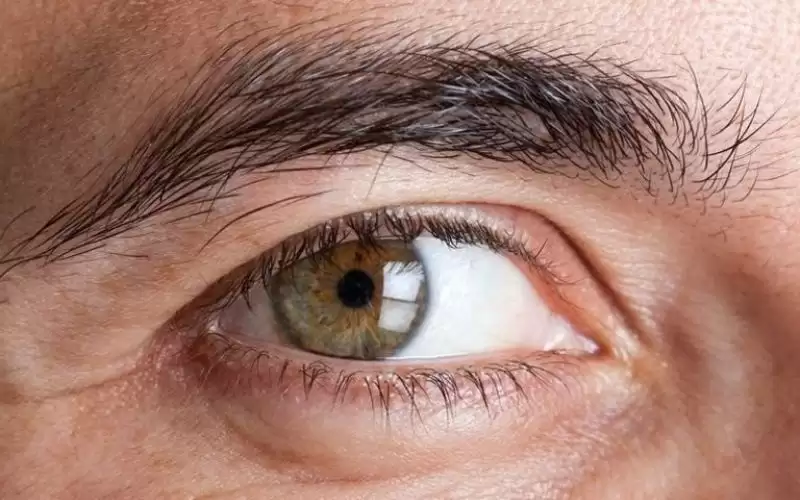 التنكس البقعي والبهاق.. لون العينين يكشف