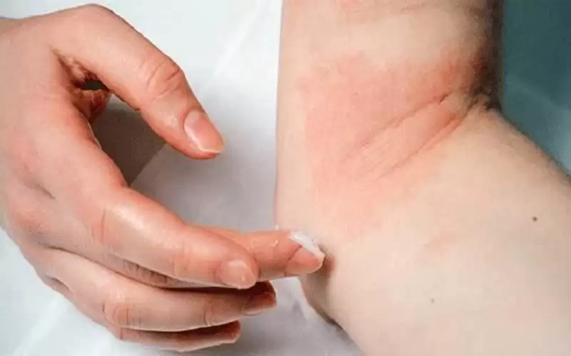 ما سبب ظهور البقع الحمراء على