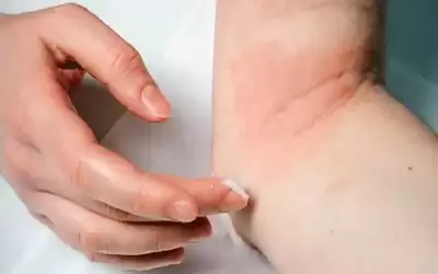 ما سبب ظهور البقع الحمراء على
