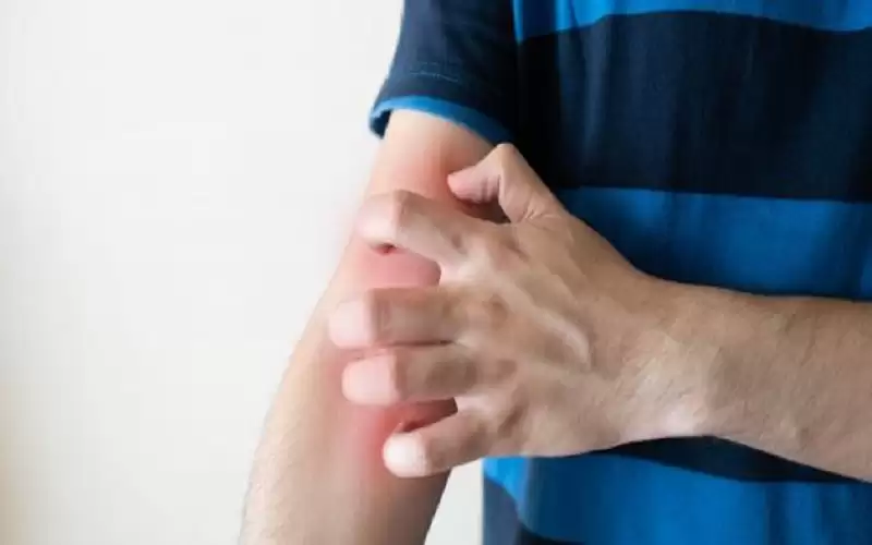 الطفح الجلدي الحراري في الشتاء ..