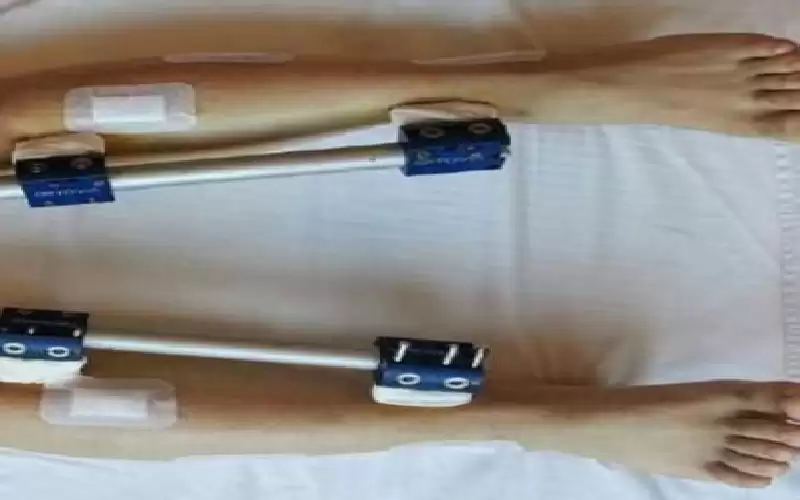 جراحات كسر الساق.. حلم الإطالة ليس