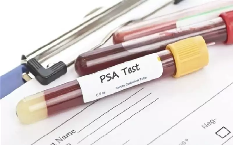 بداية من 45 عاما.. .فحص البروستاتا