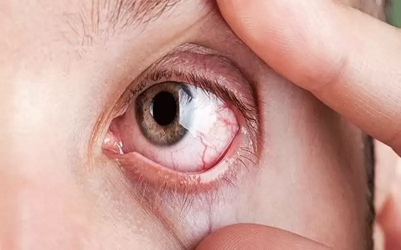 العمى مرتبط بأمراض القلب والأوعية الدموية