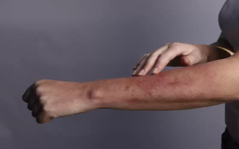 آفات جلدية تشير ملاحظتها إلى المراحل